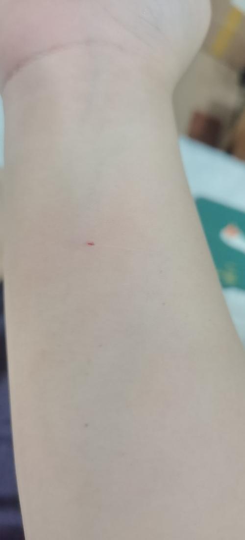 被自己的猫咪咬出血了,被自己的猫咪咬出血了需要打针吗,被自己的猫咪咬出血了